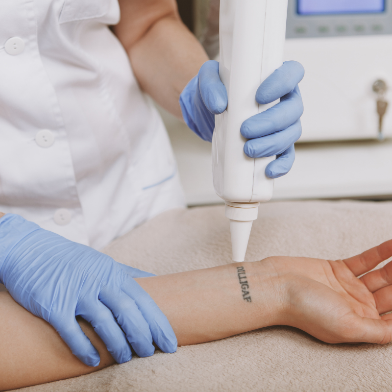 Tattoo Removal